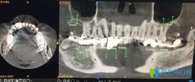 南通摩爾口腔術前手術設計