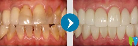 南京雅康張文震美容冠案例 南京雅康張文震美容冠案例