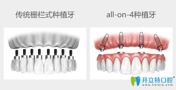 傳統(tǒng)種牙與all-on-4種植牙技術(shù)對比