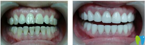 廣州圣貝口腔烤瓷牙種植案例對(duì)比圖 廣州圣貝口腔烤瓷牙種植案例對(duì)比圖