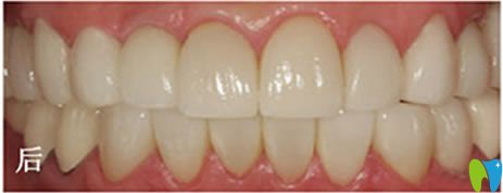 在南京雅康做全瓷貼面美牙效果 在南京雅康做全瓷貼面美牙效果