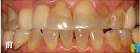 做瓷貼面美白前的四環(huán)素牙 做瓷貼面美白前的四環(huán)素牙