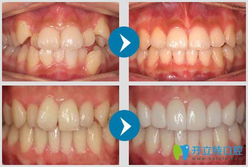 南京雅康隱形矯正真人案例