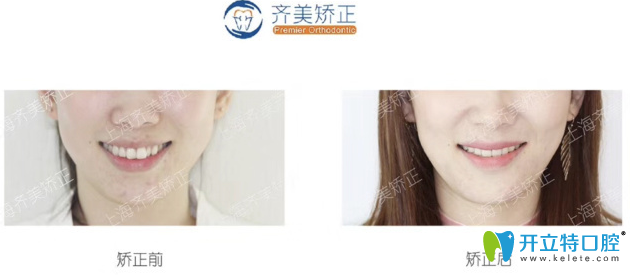 <!--<i data=20240703-sp></i>-->齊美牙齒矯正對(duì)比案例 <!--<i data=20240703-sp></i>-->齊美牙齒矯正對(duì)比案例