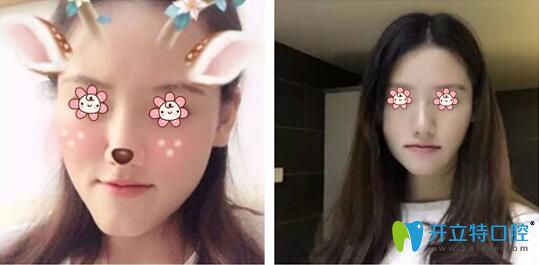 張揚(yáng)主任口腔正畸案例 張揚(yáng)主任口腔正畸案例