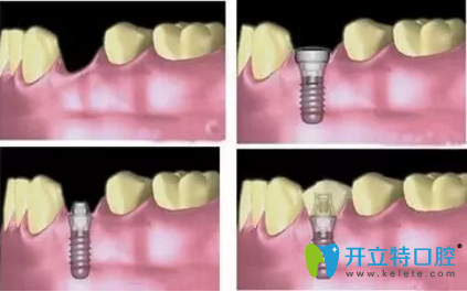 ITI種植材料采用四級純鈦材料 ITI種植材料采用四級純鈦材料