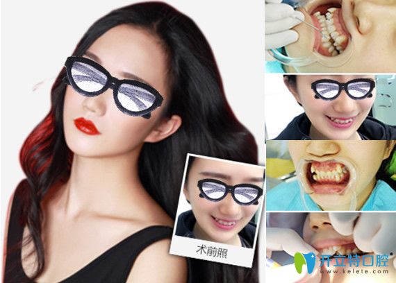 重慶牙博士口腔矯正過程及對(duì)比圖