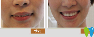寧波牙博士口腔美牙冠矯正術(shù)前術(shù)后對比圖