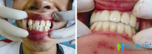 覃艷楠醫(yī)師地包天矯正案例