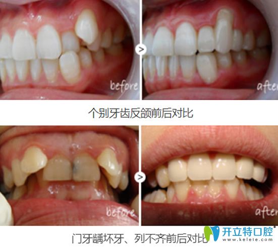 重慶牙博士口腔葉金平牙齒修復(fù)案例對比圖