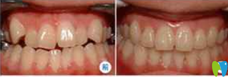 我牙齒稀疏牙縫大 在福州美可普口腔做牙齒矯正時(shí)沒帶牙套