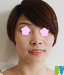 寧波牙博士口腔仿生美牙冠矯正前照片