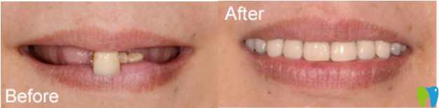 洛陽牙齒矯正案例效果 洛陽牙齒矯正案例效果