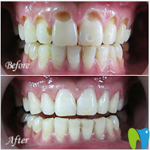 廣州暨博口腔黃曉雁前牙齲齒修補(bǔ)案例圖