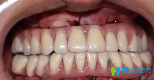 徐孟輝種植完即刻牙齒情況照片