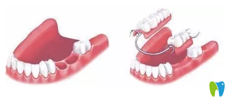 傳統(tǒng)義齒修復(fù)