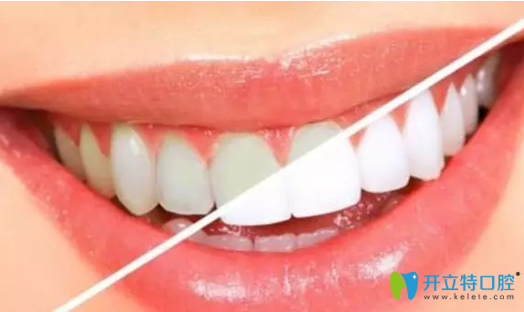 咸陽(yáng)三秦牙齒美白效果