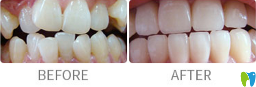 傳統(tǒng)矯正案例