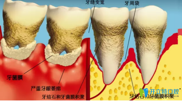 導(dǎo)致牙周病的原因 導(dǎo)致牙周病的原因