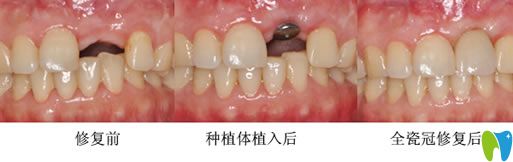 長春晟諾口腔唐永旺院長種植牙案例 長春晟諾口腔唐永旺院長種植牙案例