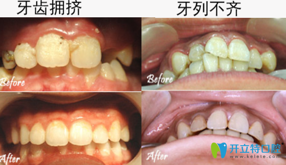 惠州致美口腔高自立牙齒正畸矯正案例