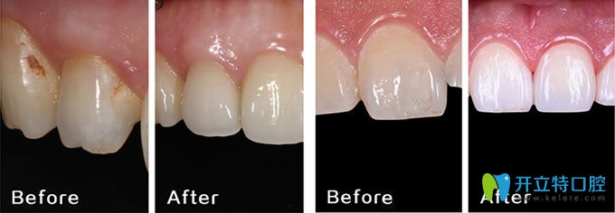 長春晟諾口腔牙齒修復案例 長春晟諾口腔牙齒修復案例
