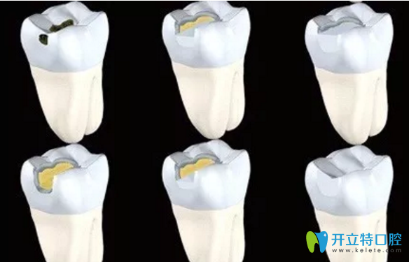 齲齒填充 齲齒填充