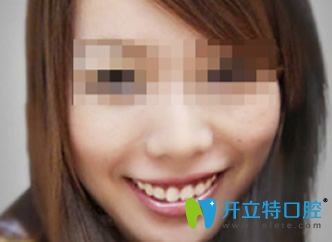 珠海拜博口腔無托槽隱形矯正效果