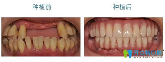 南京丹德齒科婁鐵贏種植牙案例 南京丹德齒科婁鐵贏種植牙案例