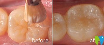 兒童齒科案例分享 兒童齒科案例分享
