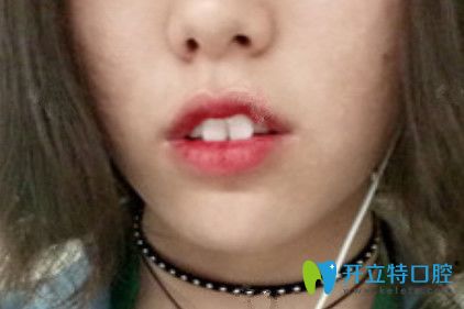 在九江奇洋口腔做了牙齒矯正，我擺脫了“兔牙妹”稱號