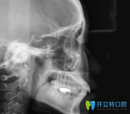 惠州致美口腔牙齒矯正前拍的X光片