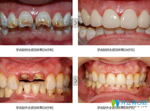 江蘇鎮(zhèn)江拜博口腔牙齒美學修復案例 江蘇鎮(zhèn)江拜博口腔牙齒美學修復案例