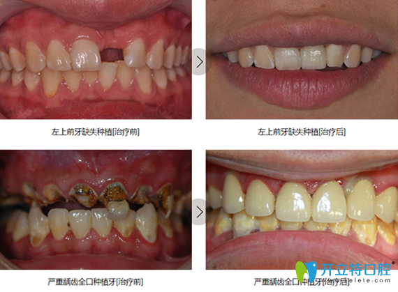 鎮(zhèn)江拜博口腔牙齒種植案例對比圖 鎮(zhèn)江拜博口腔牙齒種植案例對比圖