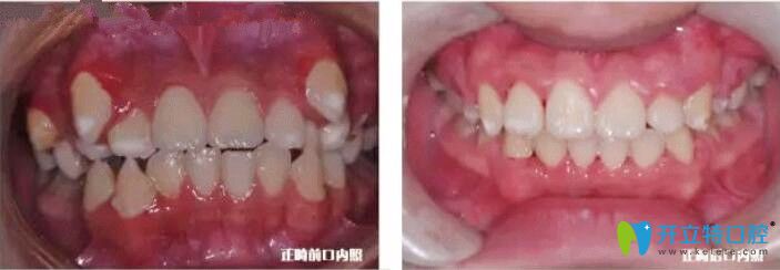 張學鵬主任牙齒正畸案例