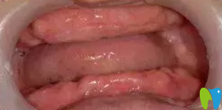 67歲的郭先生在鎮(zhèn)江拜博口腔做All-on-4種植牙真實(shí)報(bào)道