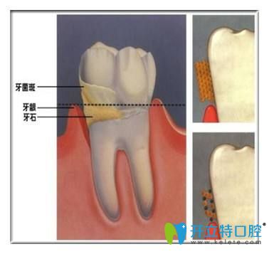 牙結(jié)石的危害你知道嗎？告別牙結(jié)石可以用這7種方法