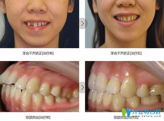 鎮(zhèn)江拜博口腔牙齒矯正前后對比照片 鎮(zhèn)江拜博口腔牙齒矯正前后對比照片
