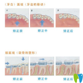 牙齒矯正過(guò)程