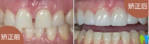 牙列稀疏、牙齒歪等矯正后效果對(duì)比圖