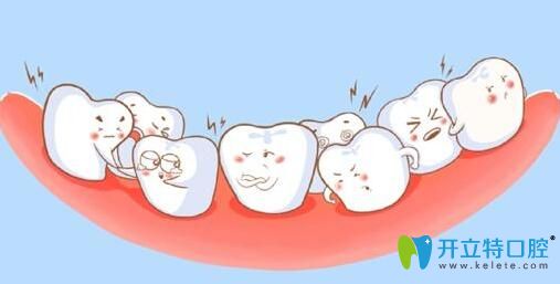 牙齒畸形牙齒擁擠