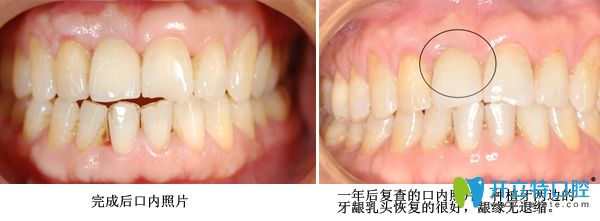 種植牙修復術(shù)后案例 種植牙修復術(shù)后案例