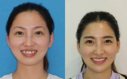 西安雁塔海濤口腔做的牙齒矯正手術(shù)，講講我有多痛苦