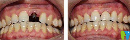 廈門宏沅膛口腔種植牙效果圖 廈門宏沅膛口腔種植牙效果圖