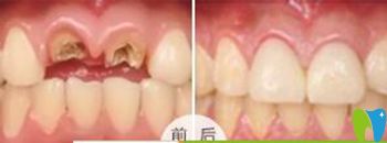 <!--<i data=20240703-sp></i>-->口腔做門牙缺失種植牙修復 <!--<i data=20240703-sp></i>-->口腔做門牙缺失種植牙修復