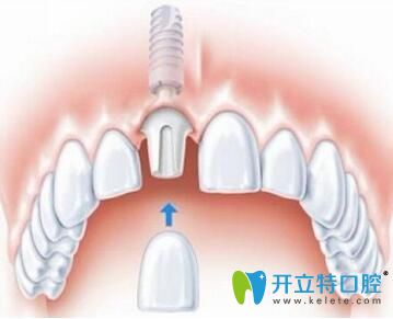 <!--<i data=20240703-sp></i>-->口腔做種植牙 <!--<i data=20240703-sp></i>-->口腔做種植牙