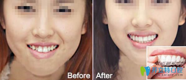 時代天使隱形牙齒正畸前對比圖 時代天使隱形牙齒正畸前對比圖