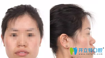 西安小白兔口腔做的牙齒矯正手術(shù)，忍受非一般的痛苦