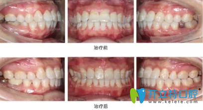 完全恢復(fù)之后我簡直很開心，牙齒就這么完美了