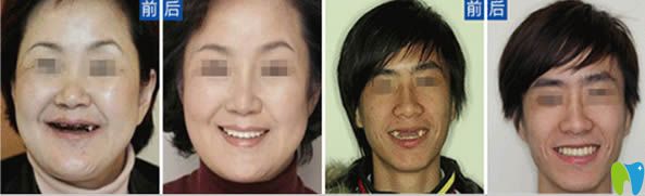 河源拜博種植牙前后對比效果 河源拜博種植牙前后對比效果